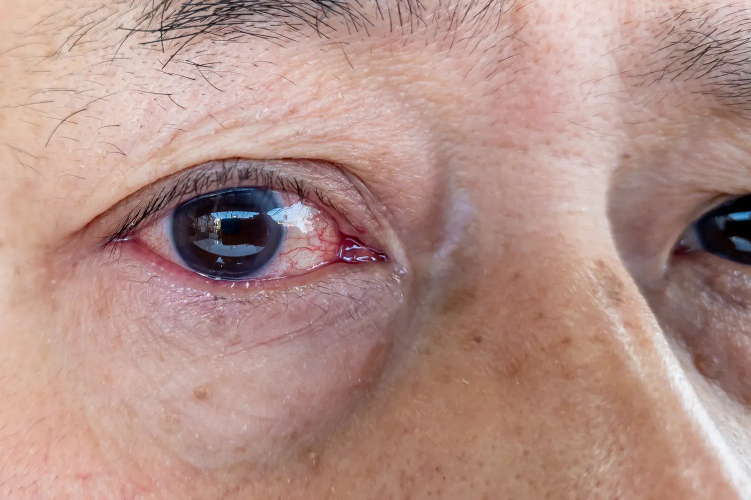 Red Veins in Eyes: Causes and Treatment